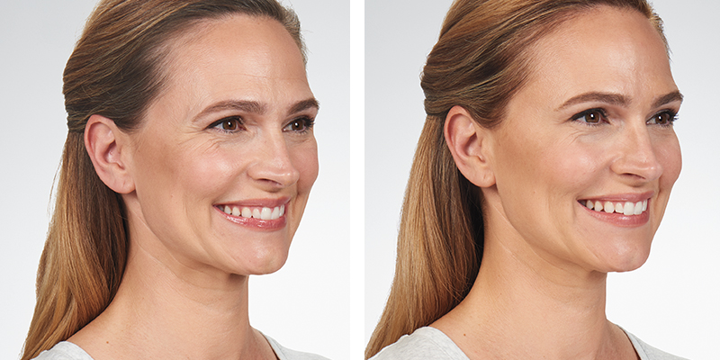 before and after shots of a woman who received Botox treatments for her face
